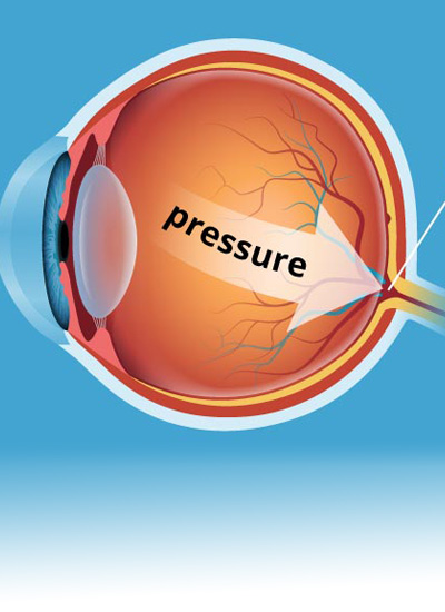 Glaucoma Treatment at ForesightClinic.com